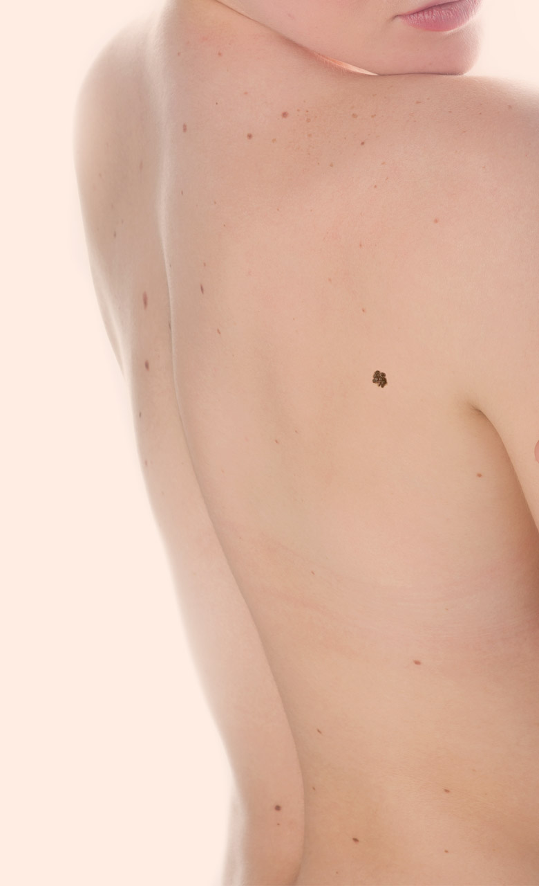 Femme de dos avec un mélanome afin d'illustrer la chirurgie reconstructive pratiqué par le Dr. Schlaudraff chez Concept Clinic, clinique de chirurgie esthétique à Genève