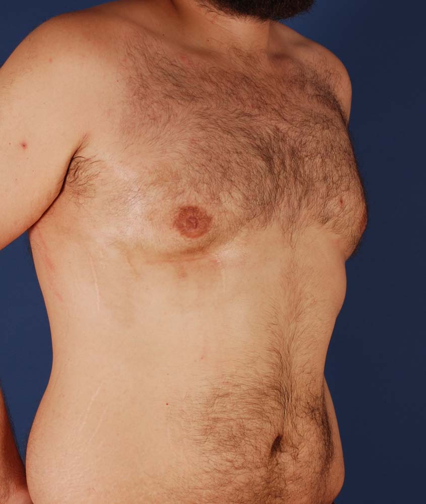 Photo oblique d'un patient après une gynécomastie par le Dr. Schlaudraff chez Concept Clinic, une clinique de chirurgie esthétique à Genève