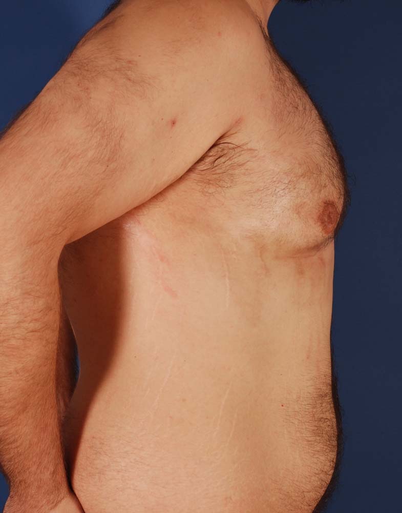 Photo de côté d'un patient après une gynécomastie par le Dr. Schlaudraff chez Concept Clinic, une clinique de chirurgie esthétique à Genève