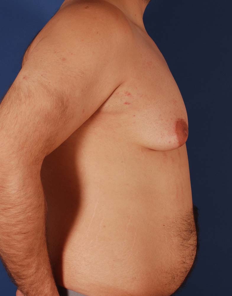 Photo de côté d'un patient avant une gynécomastie par le Dr. Schlaudraff chez Concept Clinic, une clinique de chirurgie esthétique à Genève