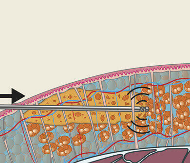 Illustration de la technique VASER High Definition Liposuccion pratiqué par le chirurgien esthétique Dr Schlaudraff chez Concept Clinic à Genève