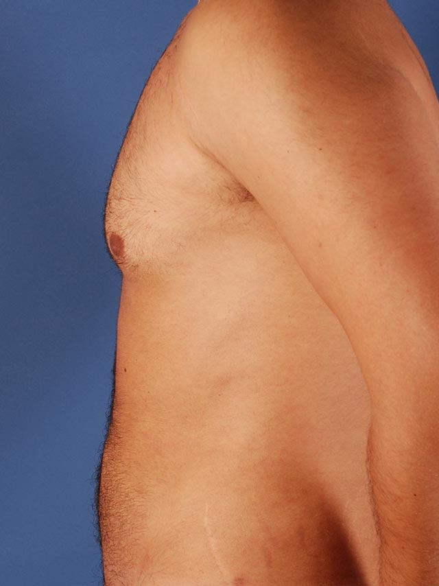 Photo de côté d'un patient avant une liposuccion pour les hommes par le Dr. Schlaudraff chez Concept Clinic, une clinique de chirurgie esthétique à Genève