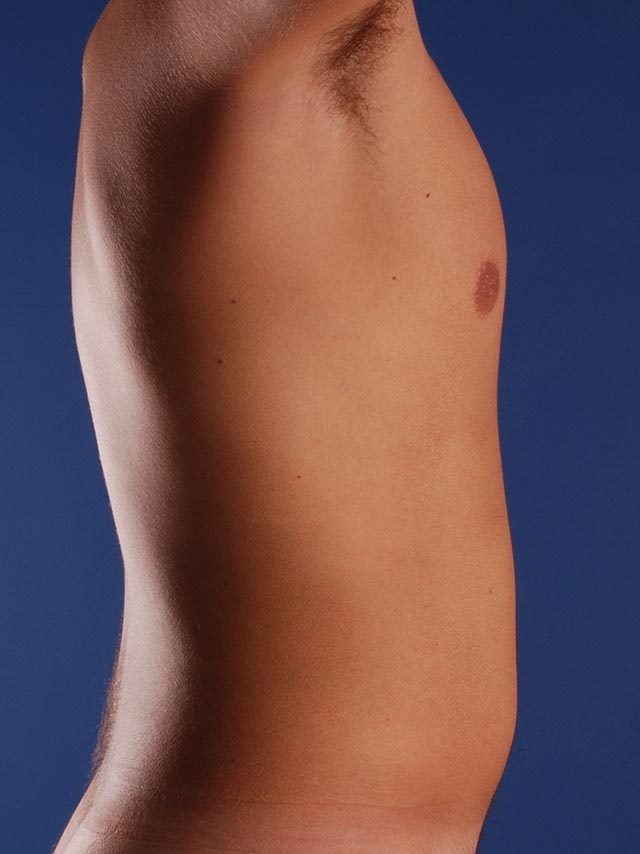 Photo de côté d'un patient avant une liposuccion pour les hommes par le Dr. Schlaudraff chez Concept Clinic, une clinique de chirurgie esthétique à Genève