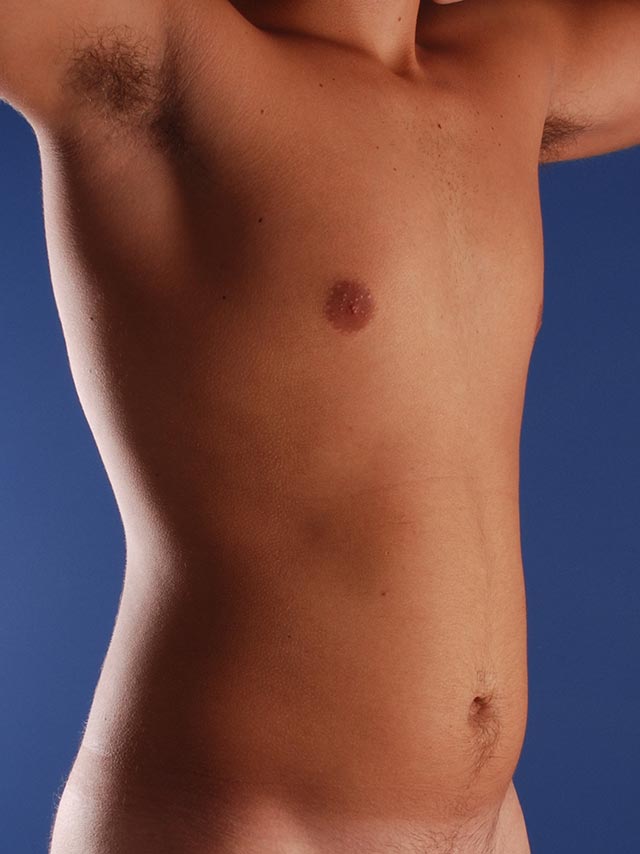 Photo oblique d'un patient avant une liposuccion pour les hommes par le Dr. Schlaudraff chez Concept Clinic, une clinique de chirurgie esthétique à Genève